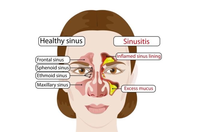 7 Common Reasons For Sinus Infection | Funotic.com